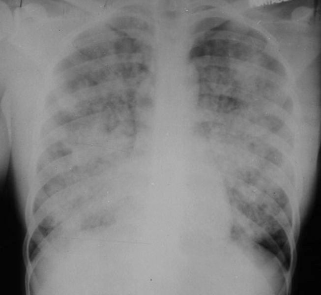 acute-respiratory-distress-syndrome