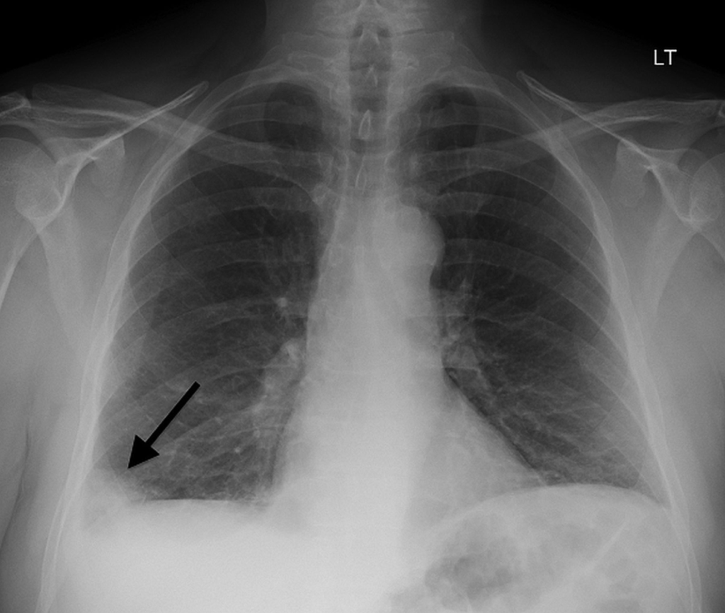 Venous thromboembolism - Critical Care Collaborative