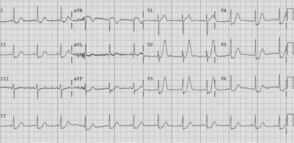 Acute coronary syndrome